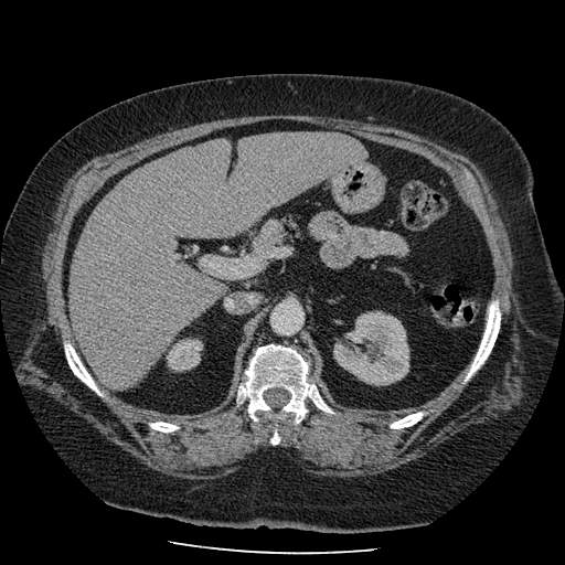 Bovine aortic arch - right internal mammary vein drains into the superior vena cava (Radiopaedia 63296-71875 A 194).jpg