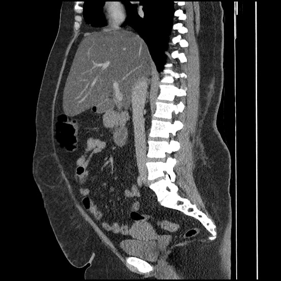 Bowel and splenic infarcts in acute lymphocytic leukemia (Radiopaedia 61055-68913 C 45).jpg