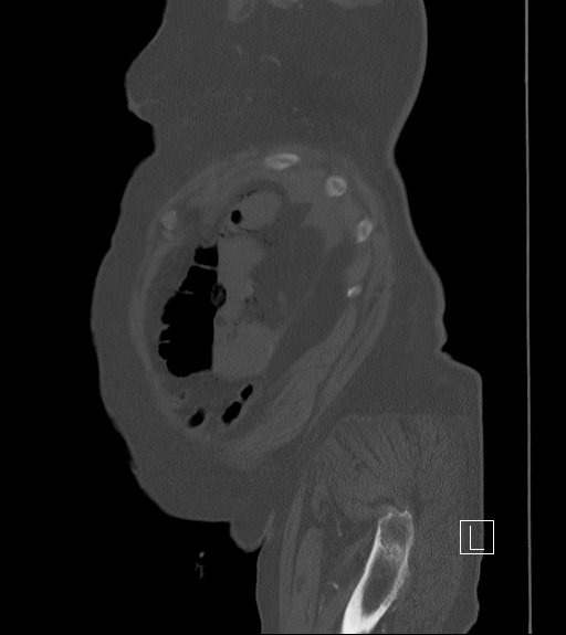 Bowel ischemia secondary to SMA occlusion with extensive portomesenteric venous gas (Radiopaedia 54656-60871 Sagittal bone window 105).jpg