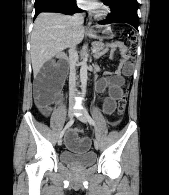 Bowel obstruction from colon carcinoma (Radiopaedia 22995-23028 C 39).jpg