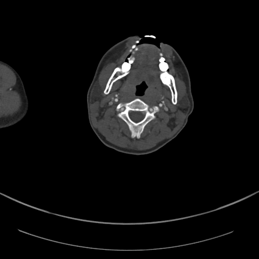 Brachiocephalic trunk pseudoaneurysm (Radiopaedia 70978-81191 Axial bone window 6).jpg