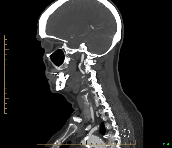 Brachiocephalic trunk stenosis (Radiopaedia 87242-103519 C 23).jpg