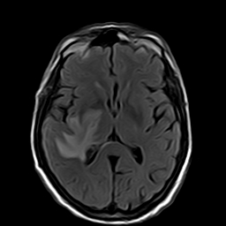 File:Brain abscess complicated by intraventricular rupture and ventriculitis (Radiopaedia 82434-96571 Axial FLAIR 12).jpg