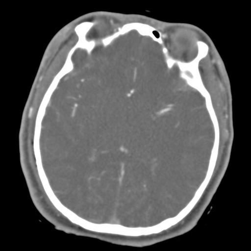 Brain contusions, internal carotid artery dissection and base of skull fracture (Radiopaedia 34089-35339 D 28).png