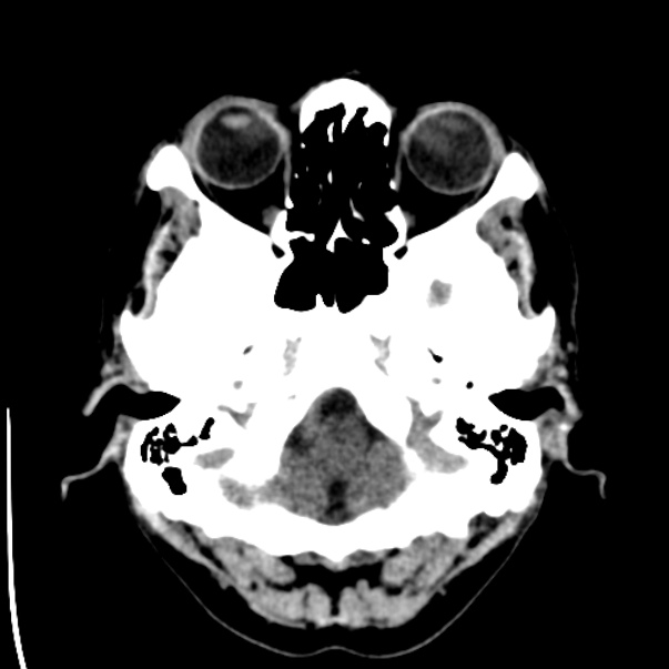 Brain metastases from lung cancer (Radiopaedia 24480-24781 Axial non-contrast 4).jpg