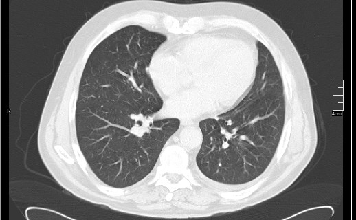 Brain metastases from squamocellular lung cancer (Radiopaedia 56515-63219 Axial lung window 41).jpg