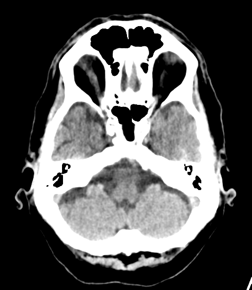 File:Brain metastasis (lung cancer) (Radiopaedia 48289-53177 Axial non-contrast 6).png