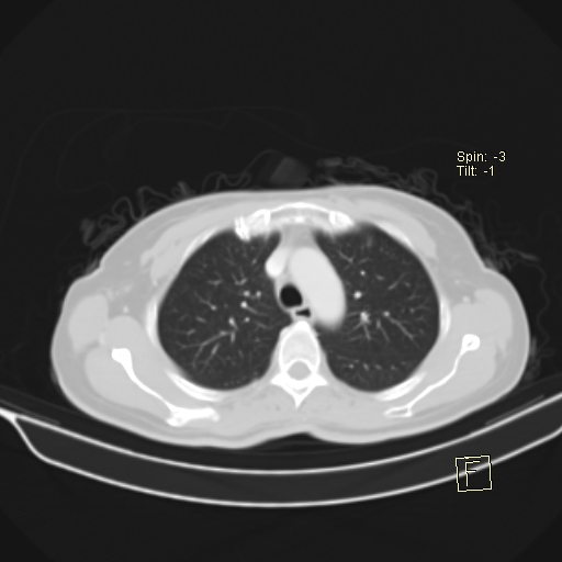 Brain metastasis as initial presentation of non-small cell lung cancer (Radiopaedia 65122-74127 Axial lung window 14).jpg