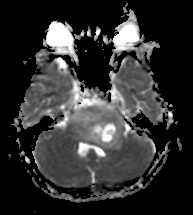 File:Brainstem glioma (Radiopaedia 9444-10124 Axial ADC 1).jpg