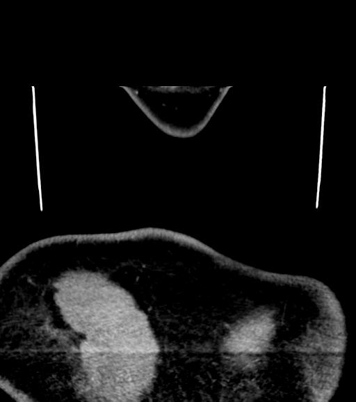 Branchial cleft cyst (Radiopaedia 31167-31875 Coronal C+ delayed 68).jpg