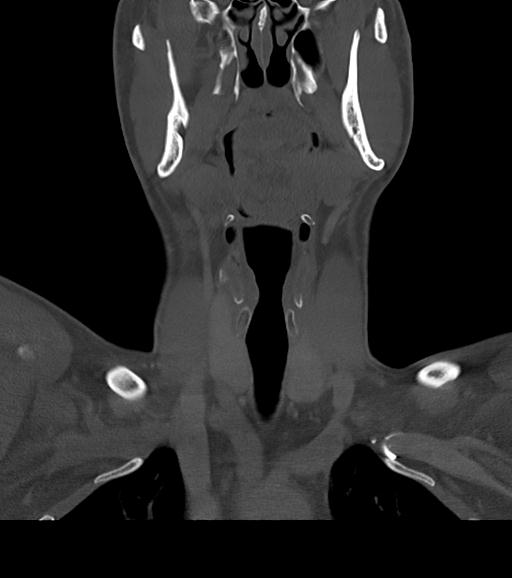 File:Branchial cleft cyst (Radiopaedia 31167-31875 Coronal bone window 28).jpg