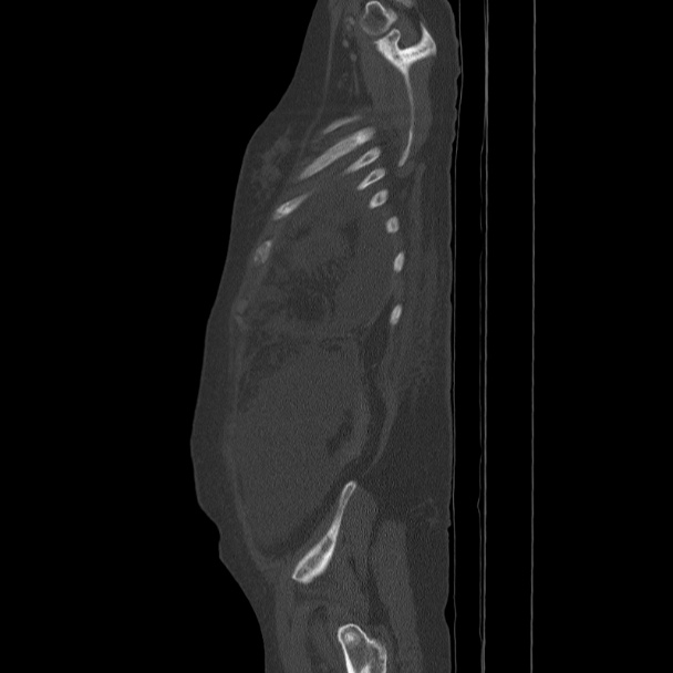 Breast cancer metastases - hepatic and skeletal (Radiopaedia 34201-35461 Sagittal bone window 82).jpg