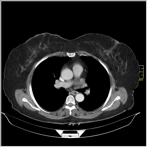 Breast cancer on thorax CT (Radiopaedia 60571-68275 A 48).JPG
