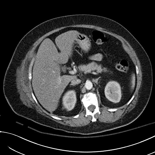 File:Breast carcinoma with pathological hip fracture (Radiopaedia 60314-67974 A 54).jpg