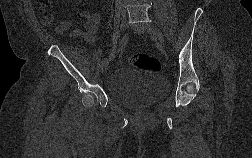 File:Breast carcinoma with pathological hip fracture (Radiopaedia 60314-67993 Coronal bone window 68).jpg
