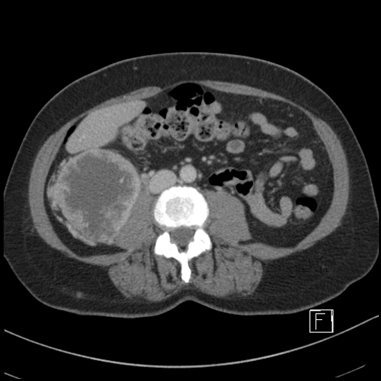 File:Breast metastases from renal cell cancer (Radiopaedia 79220-92225 C 56).jpg