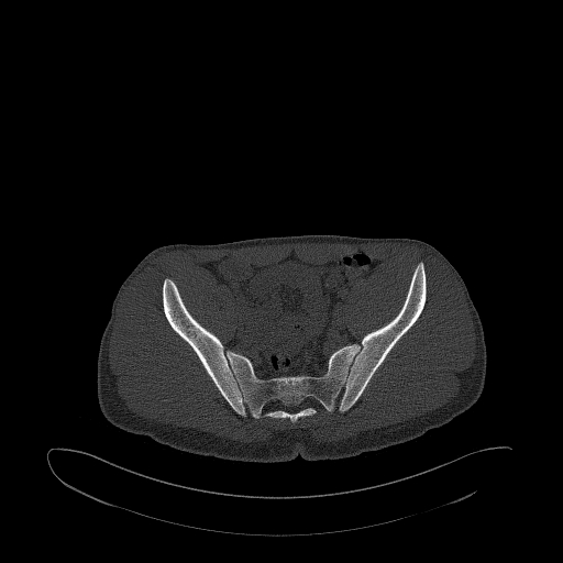 Brodie abscess- femoral neck (Radiopaedia 53862-59966 Axial bone window 71).jpg