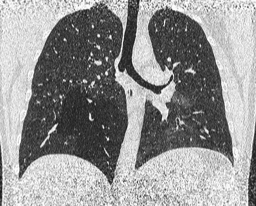 File:Bronchial atresia (Radiopaedia 58271-65417 Coronal lung window 33).jpg