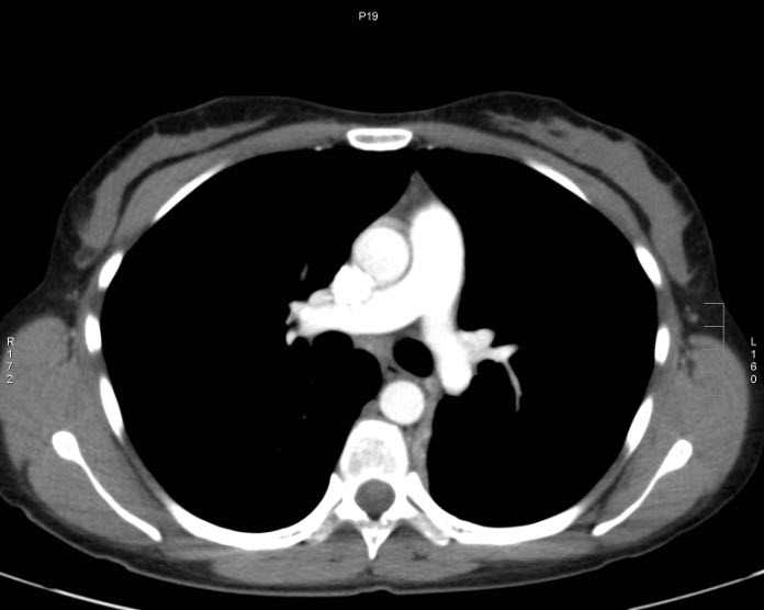 File:Bronchial carcinoid tumor (Radiopaedia 15042-42507 B 2).jpg