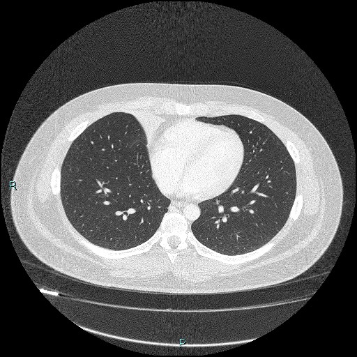 Bronchial carcinoid tumor (Radiopaedia 78272-90875 Axial lung window 33).jpg