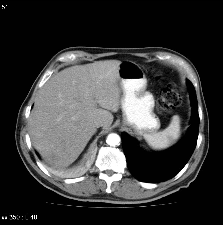 Bronchial carcinoid tumor with right lower lobe collapse (Radiopaedia 29060-29422 A 50).jpg