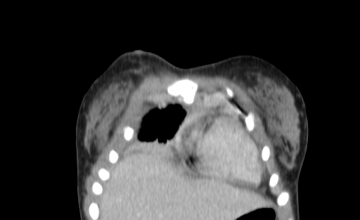 Bronchial mucoepidermoid carcinoma (Radiopaedia 57023-63895 Coronal 5).jpg