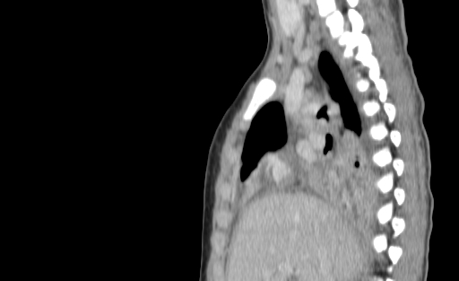 Bronchial mucoepidermoid carcinoma (Radiopaedia 57023-63895 Sagittal 88).jpg