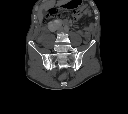 File:Bronchiectasis in Crohn disease (Radiopaedia 60311-67977 Coronal bone window 27).jpg