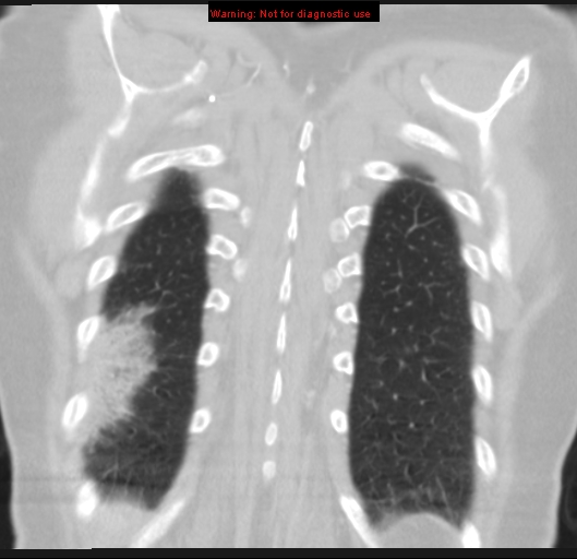 Bronchoalveolar carcinoma (BAC) (Radiopaedia 13436-13392 Coronal lung window 53).jpg