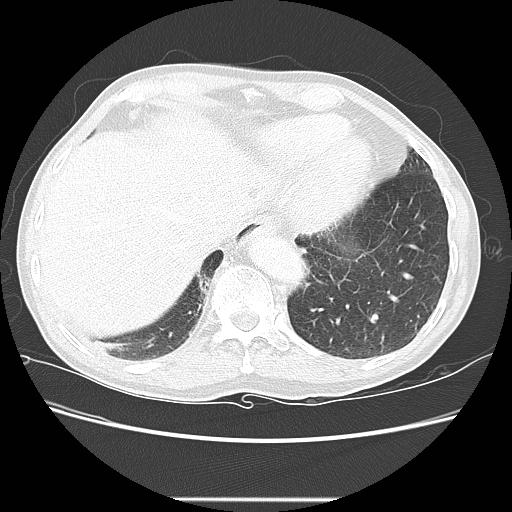 File:Bronchocele (Radiopaedia 17097-16795 Axial lung window 98).jpg