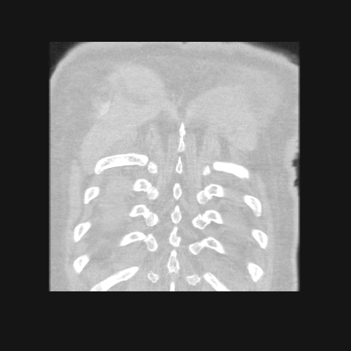 File:Bronchogenic carcinoma with metastatic lymphadenopathy (Radiopaedia 37671-39569 Coronal lung window 44).jpg