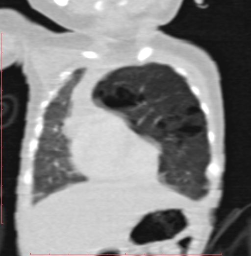 Bronchogenic cyst (Radiopaedia 78599-91409 Coronal lung window 65).jpg