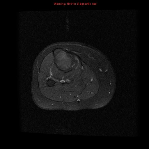 File:Brown tumor (Radiopaedia 12318-12597 Axial T1 C+ fat sat 18).jpg