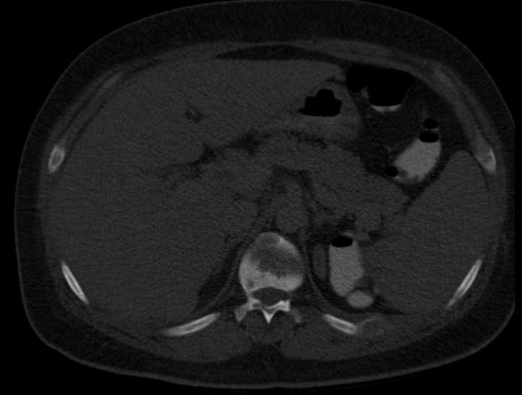File:Brown tumors compressing the spinal cord (Radiopaedia 68442-77988 Axial bone window 78).jpg