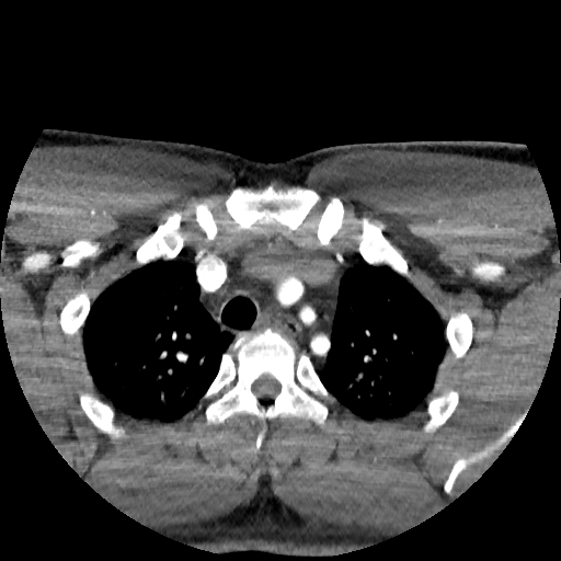 Buccal fat pad arteriovenous malformation (Radiopaedia 70936-81144 D 9).jpg