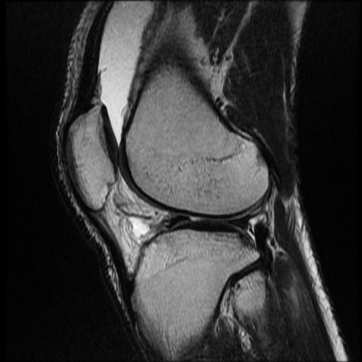 File:Bucket handle tear - medial meniscus (Radiopaedia 69245-79026 Sagittal T2 1).jpg