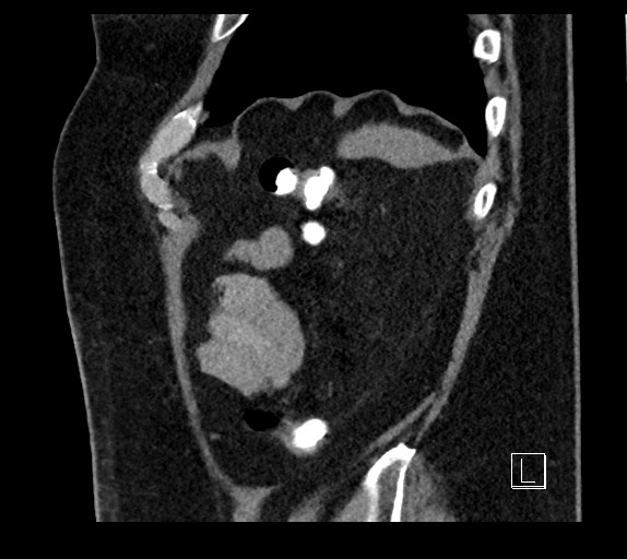 Buried bumper syndrome - gastrostomy tube (Radiopaedia 63843-72577 Sagittal Inject 17).jpg