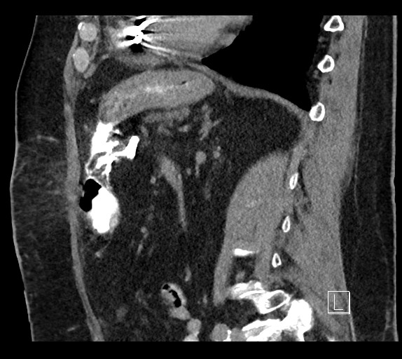 Buried bumper syndrome - gastrostomy tube (Radiopaedia 63843-72577 Sagittal Inject 47).jpg
