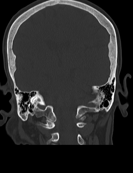 Burnt-out meningioma (Radiopaedia 51557-57337 Coronal bone window 33).jpg