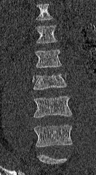 Burst fracture (Radiopaedia 53373-59357 Coronal bone window 16).jpg