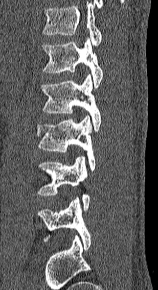 Burst fracture (Radiopaedia 53373-59357 Sagittal bone window 18).jpg