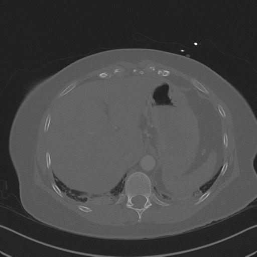 Burst fracture - thoracic spine (Radiopaedia 30238-30865 Axial bone window 80).jpg