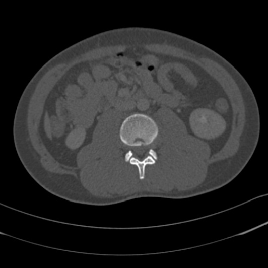 Burst fracture with cauda equina syndrome (Radiopaedia 25701-25867 Axial bone window 73).jpg