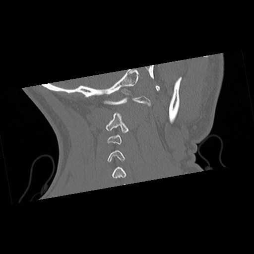 C1-C2 "subluxation" - normal cervical anatomy at maximum head rotation (Radiopaedia 42483-45607 Coronal non-contrast 49).jpg
