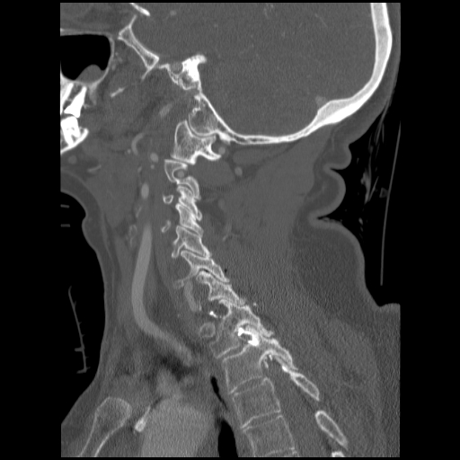 File:C1 anterior arch (plough) fracture - type 1 (Radiopaedia 76181-87720 Sagittal bone window 42).jpg