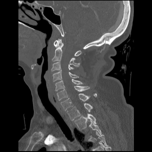 File:C1 anterior arch (plough) fracture - type 1 (Radiopaedia 76181-87720 Sagittal bone window 57).jpg
