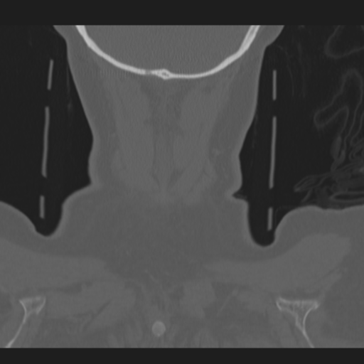 C2 fracture (Radiopaedia 34091-35341 Coronal bone window 60).png