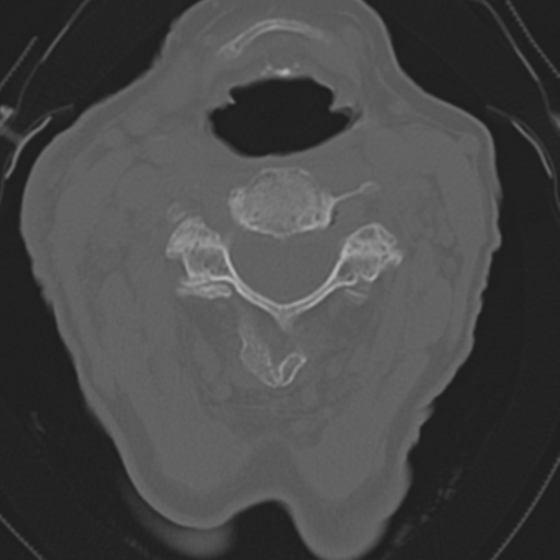 File:C2 fracture with vertebral artery dissection (Radiopaedia 37378-39199 Axial bone window 24).png