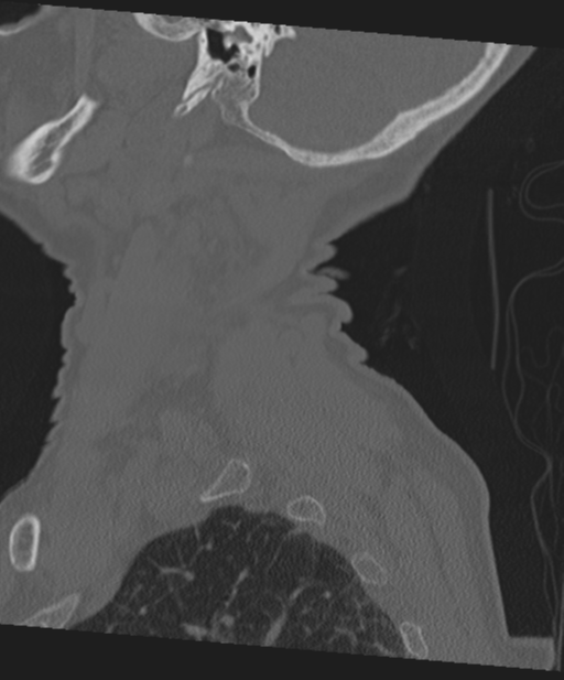 C2 fracture with vertebral artery dissection (Radiopaedia 37378-39199 Sagittal bone window 68).png