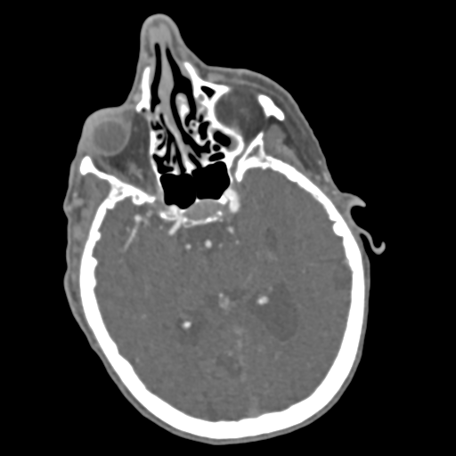 File:C2 fracture with vertebral artery dissection (Radiopaedia 37378-39200 A 235).png